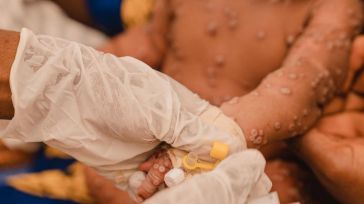 Alerta mundial: La OMS aprueba la primera vacuna contra el mpox