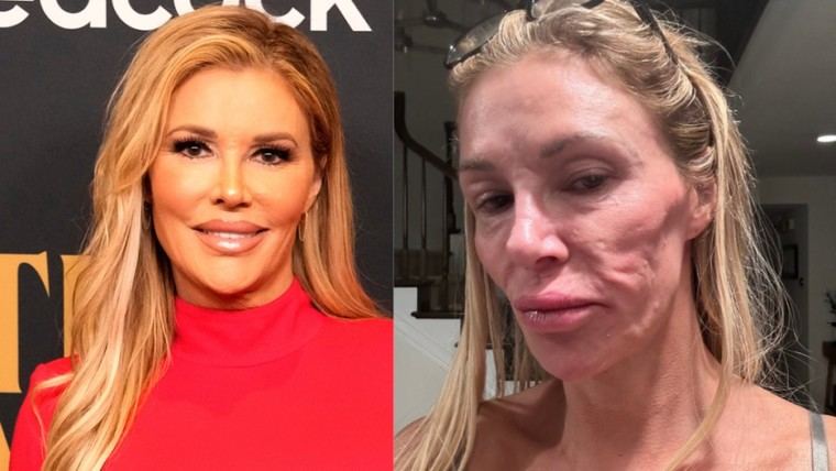 Brandi Glanville revela problemas faciales tras recibir la vacuna contra COVID