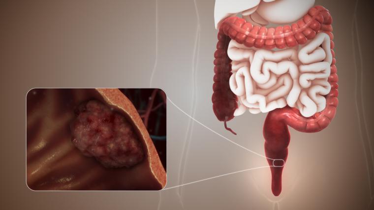 El cáncer de colon aumentó un 500% entre los vacunados contra Covid