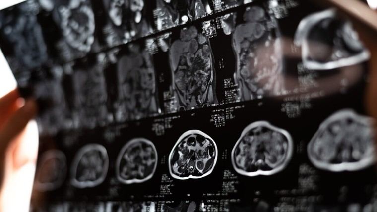 Nuevos implantes cerebrales buscan controlar la adicción en alcohólicos y drogadictos